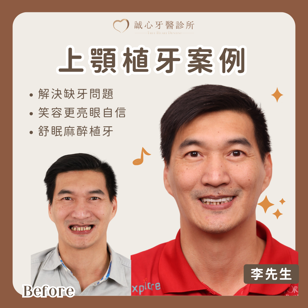 All on 4 上顎植牙案例－李先生一日重拾完美笑容的方法，高效客製化全口重建技術！