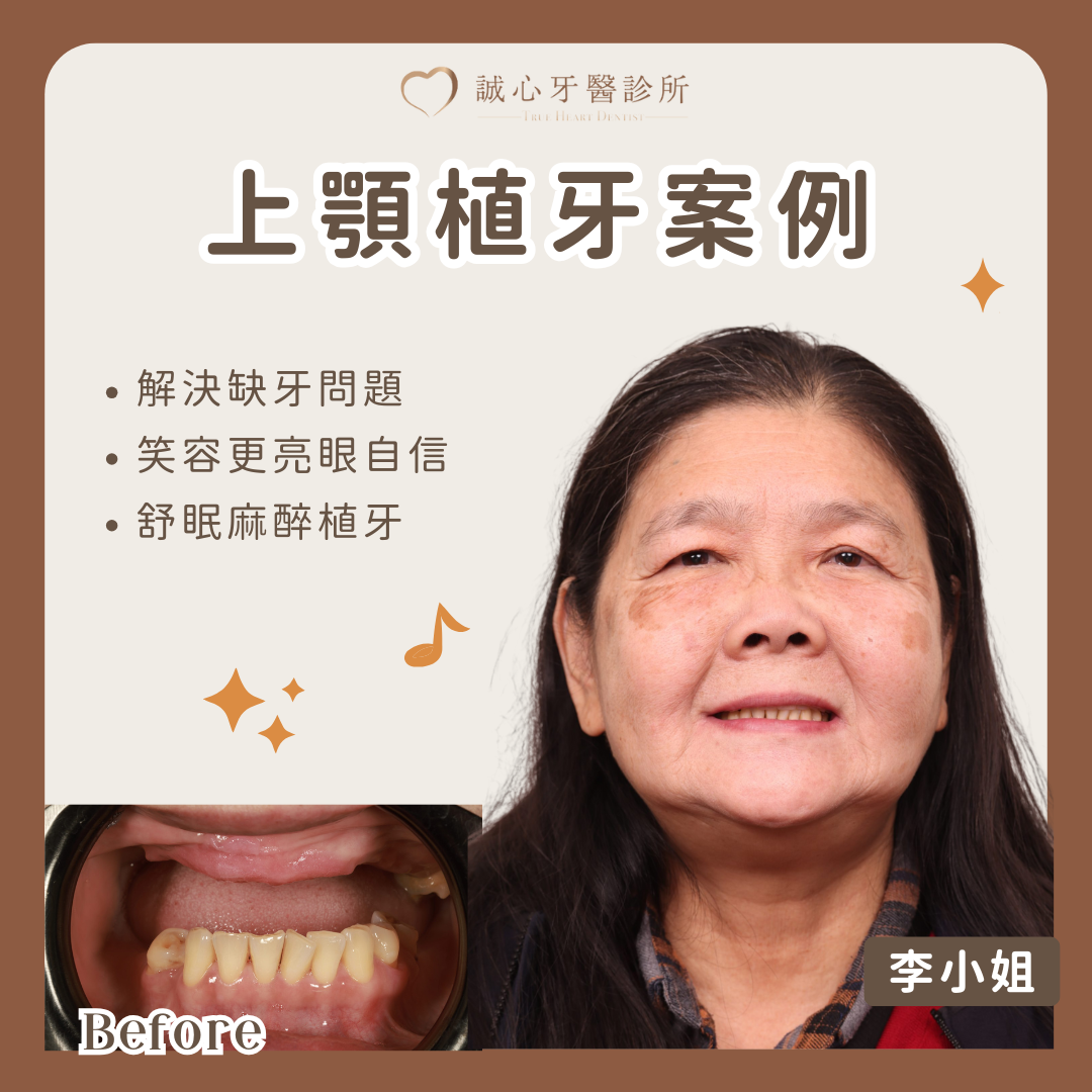 All on 4 上顎植牙案例－李小姐擺脫上排牙齒全失困擾，一日快速恢復咀嚼能力！