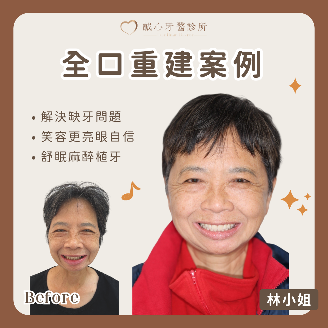 All on 4 全口重建案例－林小姐一日全口重建，找回年輕自信笑容！