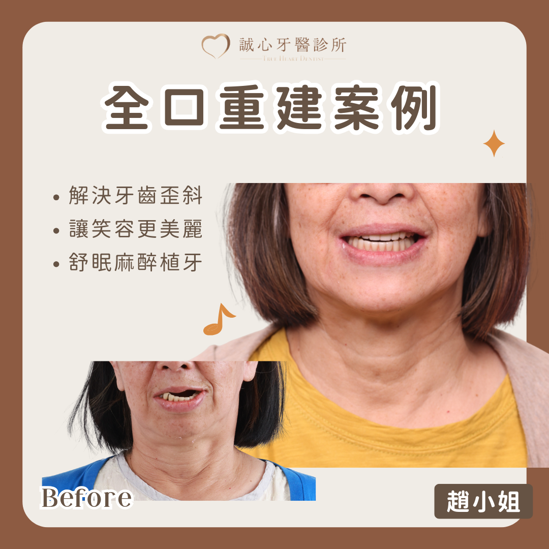 All on 4 全口重建案例－趙小姐一日全口重建，矯正牙齒，找回美麗笑容！