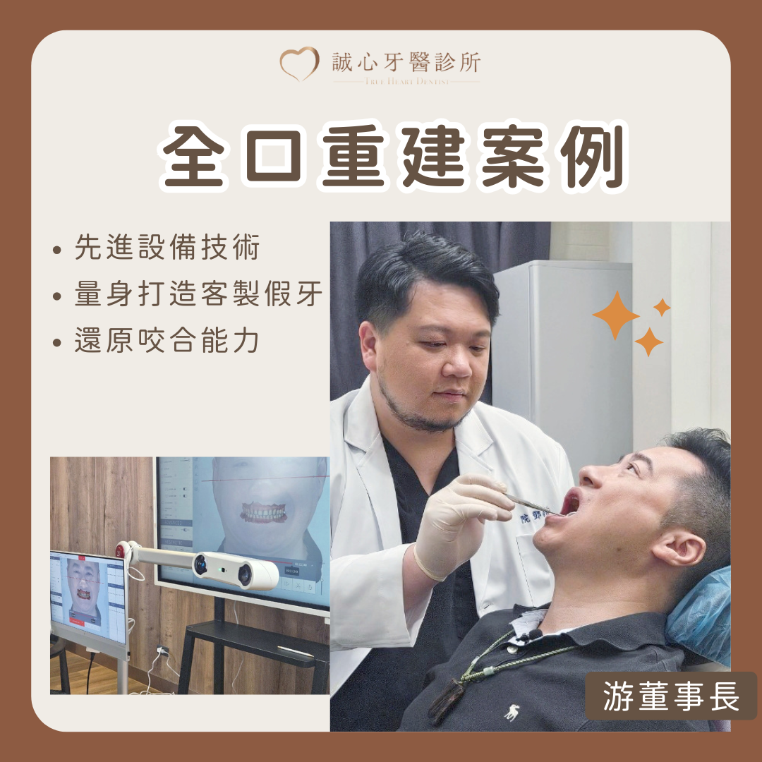 高雄 All on 4 全口重建案例－ MODJAW 4D 全時咀嚼紀錄器，為游董事長打造客製舒適穩定假牙！