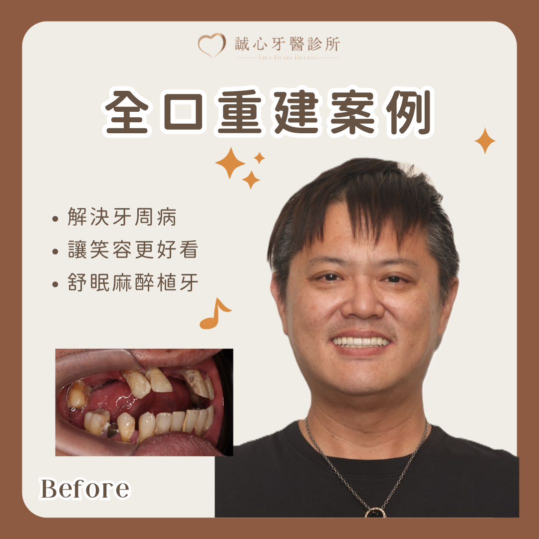 室內設計師顴骨植牙全口重建案例｜數位導航處理骨量不足與咬合重建