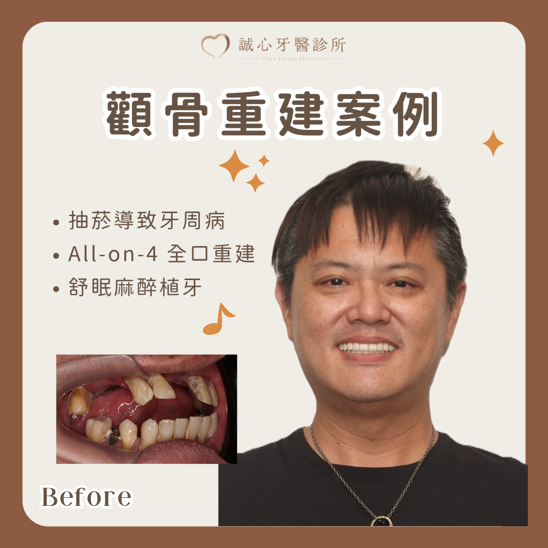室內設計師顴骨植牙全口重建案例｜數位導航處理骨量不足與咬合重建