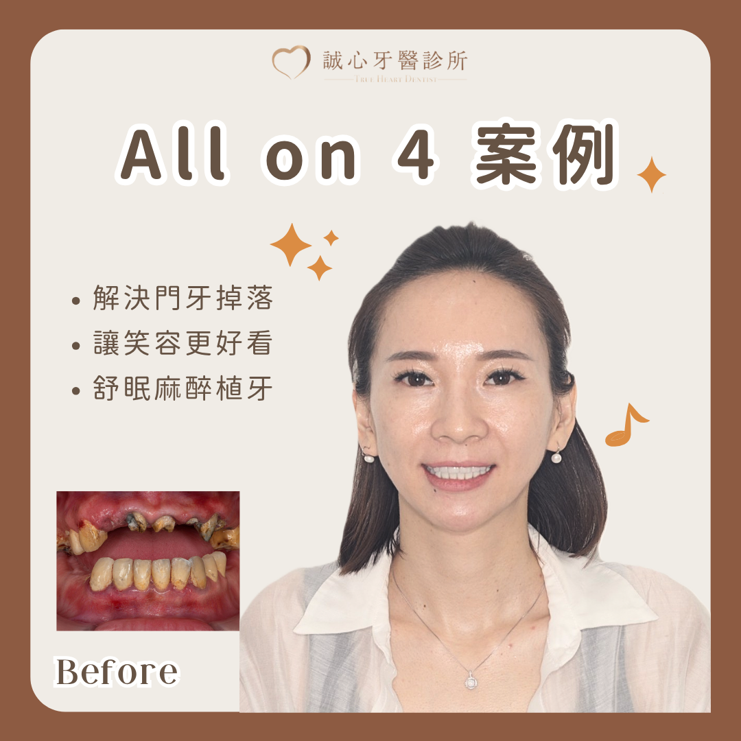 直播主美學全口重建案例｜上顎 All-on-4、下顎全瓷冠與植牙規劃