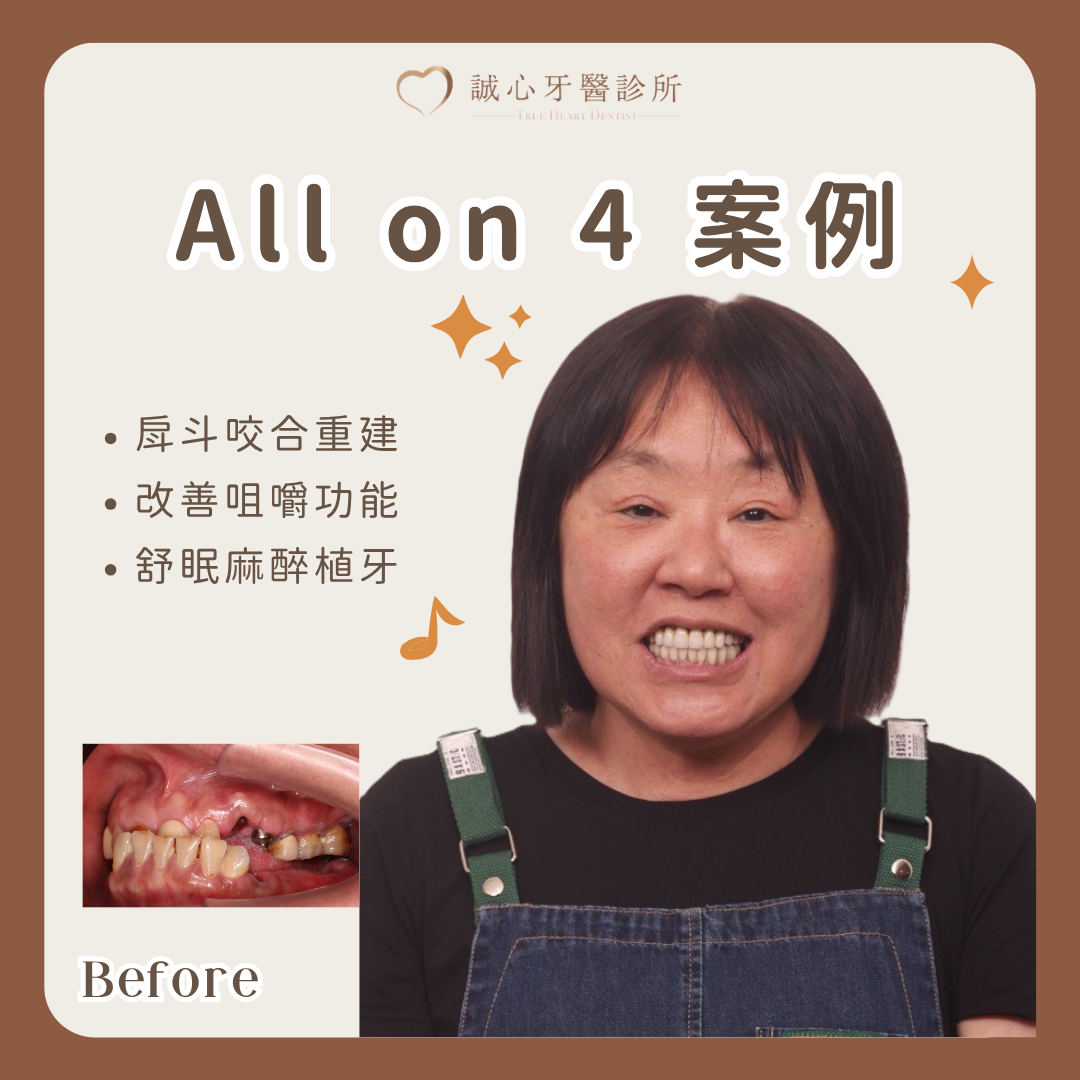 台商數位全口重建案例｜依行程安排 All-on-4 與咬合重建