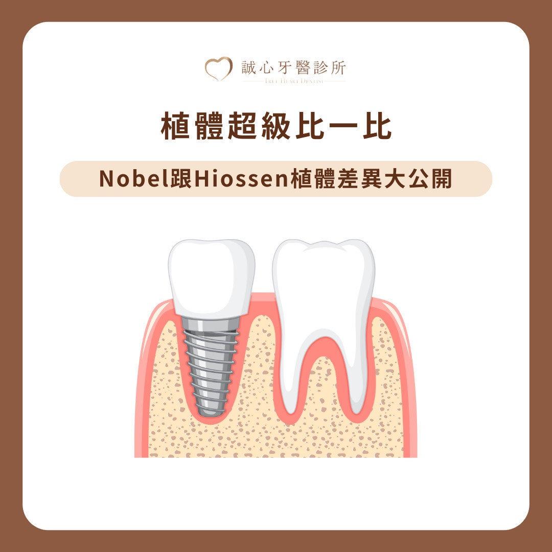 Nobel 諾保科和 Hiossen 植體怎麼選？兩款常見植體比一比！